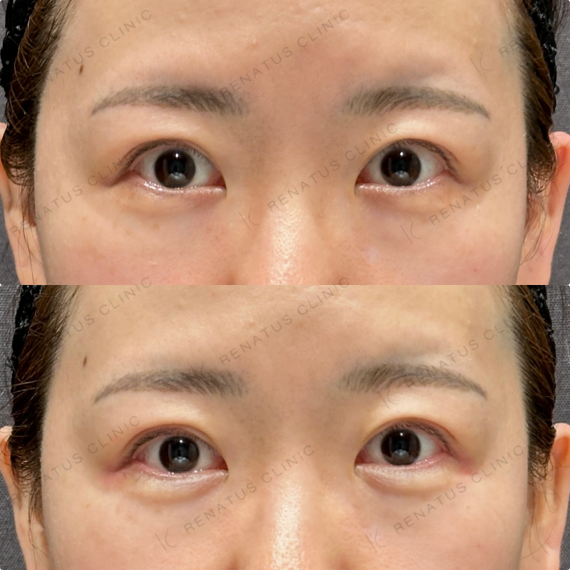 涙袋・ほうれい線ヒアルロン酸ボルベラ・ダイヤモンドフィール症例写真