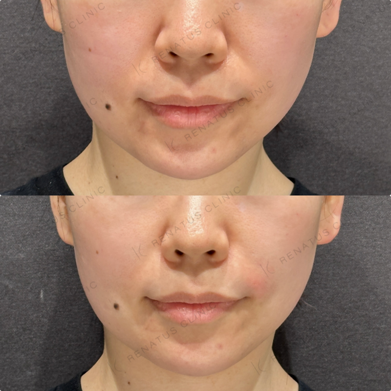 涙袋・ほうれい線ヒアルロン酸ボルベラ・ダイヤモンドフィール症例写真