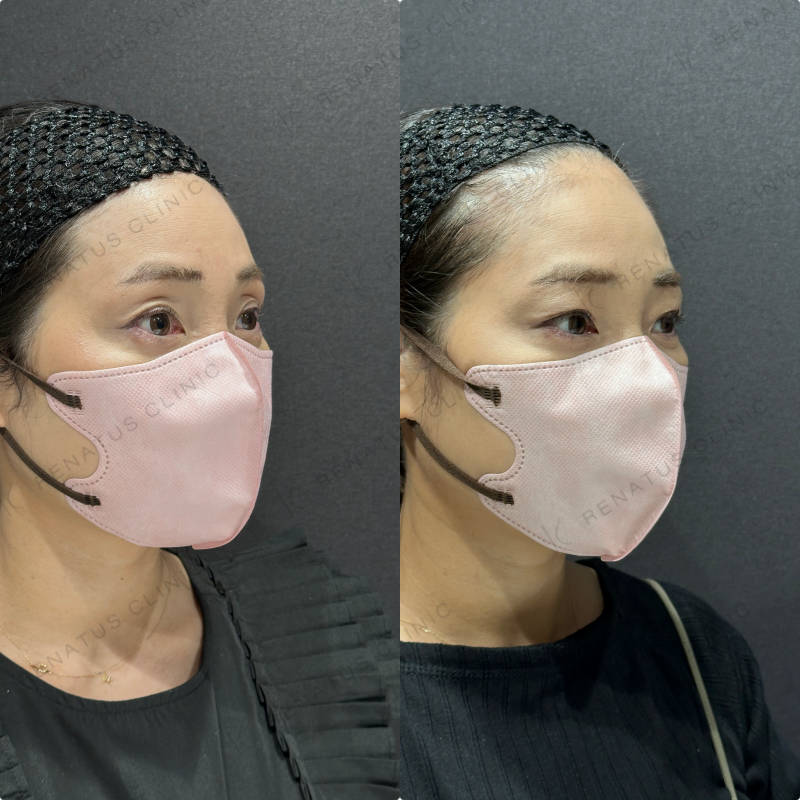 目の上ヒアルロン酸ボライト症例写真