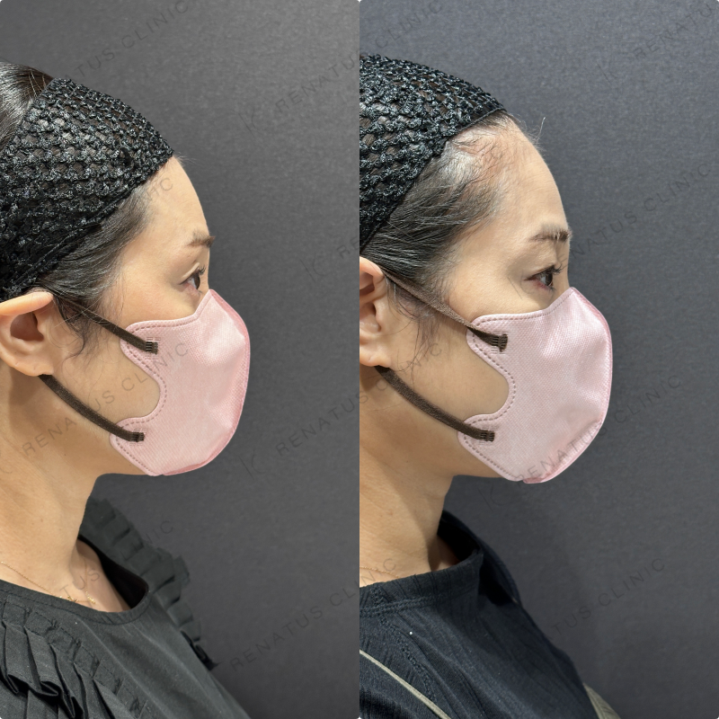 目の上ヒアルロン酸ボライト症例写真