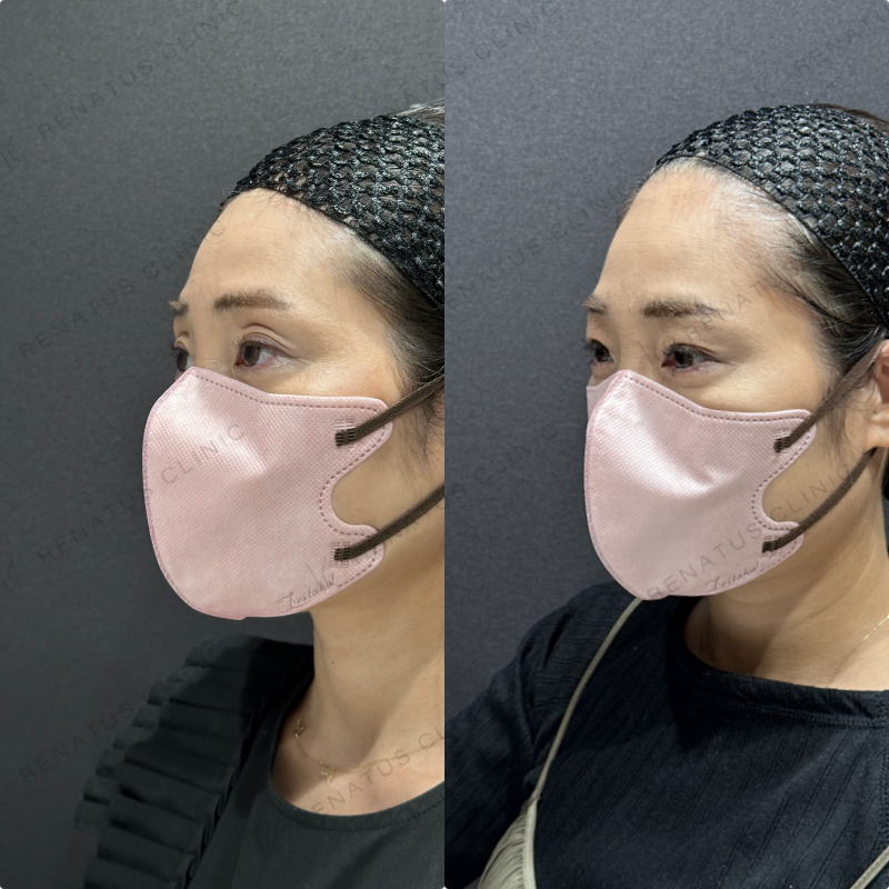 目の上ヒアルロン酸ボライト症例写真