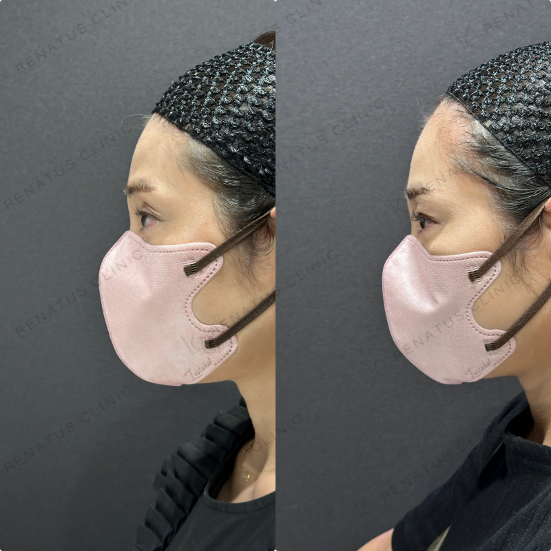 目の上ヒアルロン酸ボライト症例写真