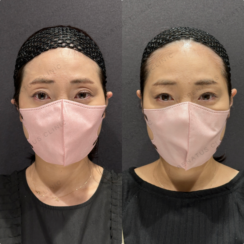 目の上ヒアルロン酸ボライト症例写真