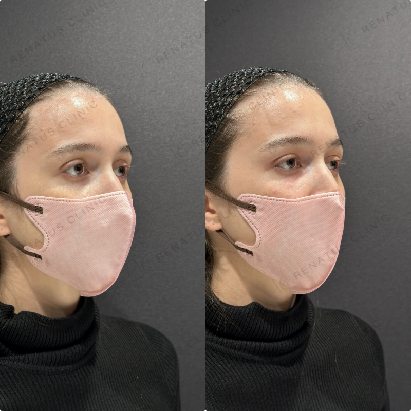 目の上・目の下ヒアルロン酸ボルベラ症例写真