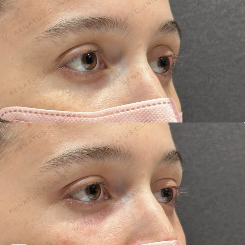 目の上・目の下ヒアルロン酸ボルベラ症例写真