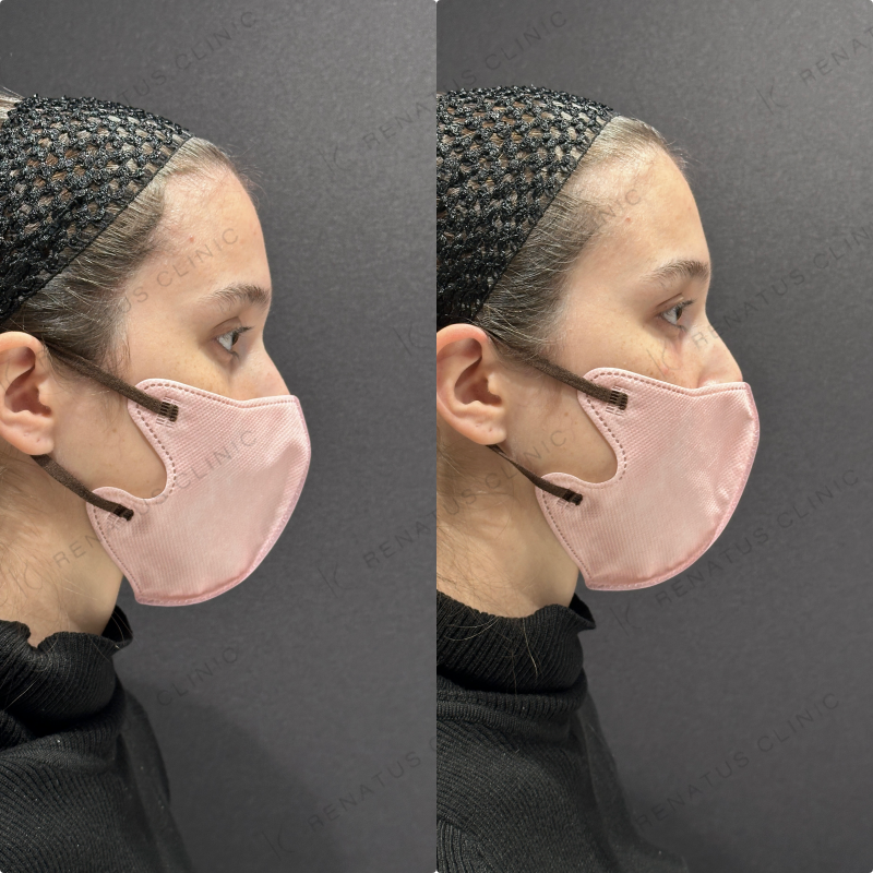 目の上・目の下ヒアルロン酸ボルベラ症例写真