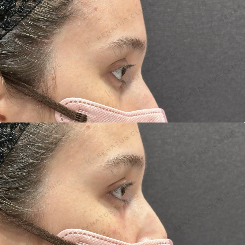 目の上・目の下ヒアルロン酸ボルベラ症例写真