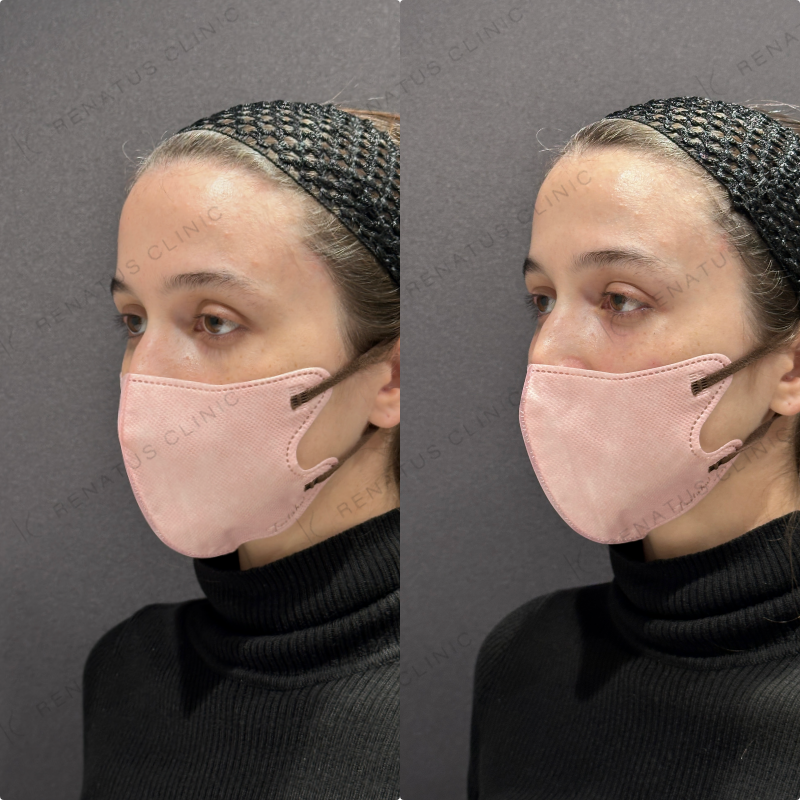 目の上・目の下ヒアルロン酸ボルベラ症例写真