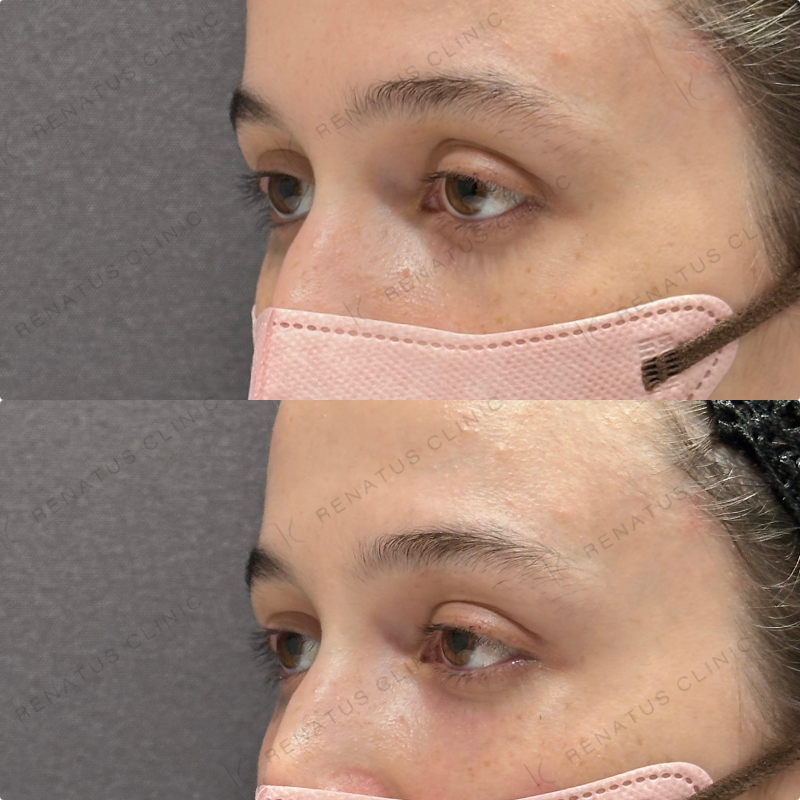 目の上・目の下ヒアルロン酸ボルベラ症例写真