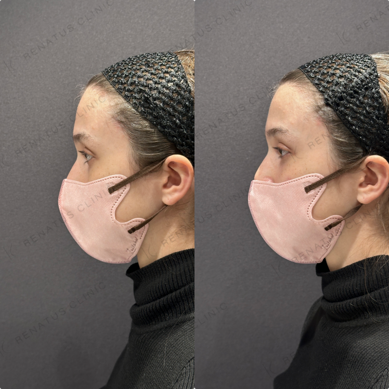 目の上・目の下ヒアルロン酸ボルベラ症例写真