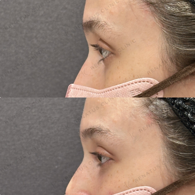 目の上・目の下ヒアルロン酸ボルベラ症例写真