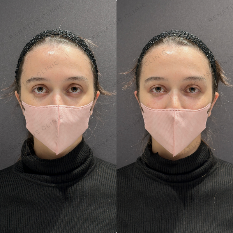 目の上・目の下ヒアルロン酸ボルベラ症例写真