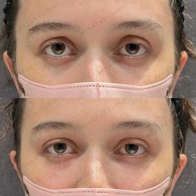 目の上・目の下ヒアルロン酸ボルベラ症例写真