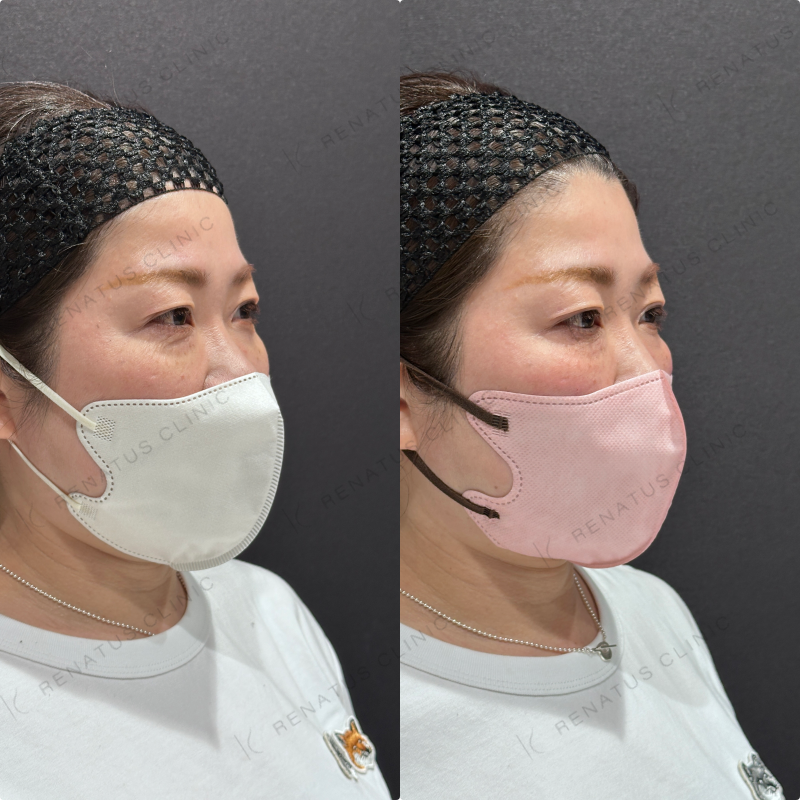 目の下ヒアルロン酸ボルベラ症例写真