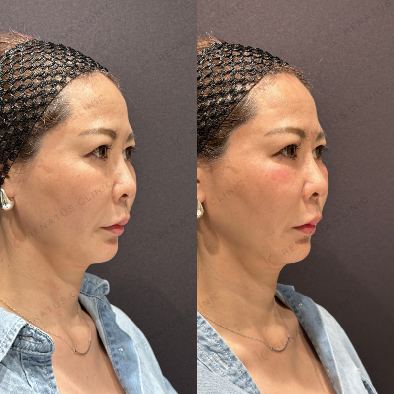 目の下ヒアルロン酸ボルベラ症例写真