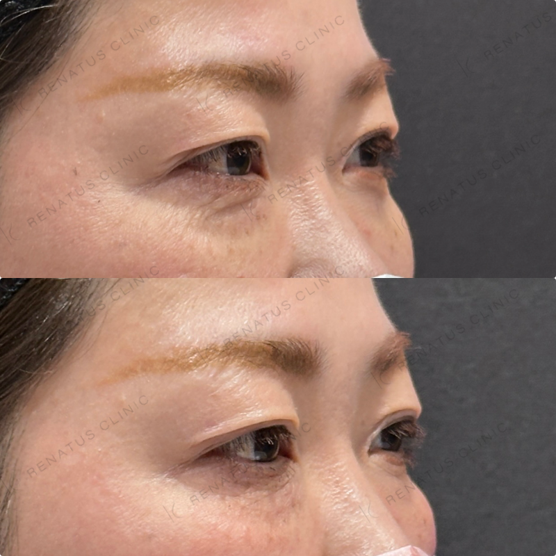 目の下ヒアルロン酸ボルベラ症例写真