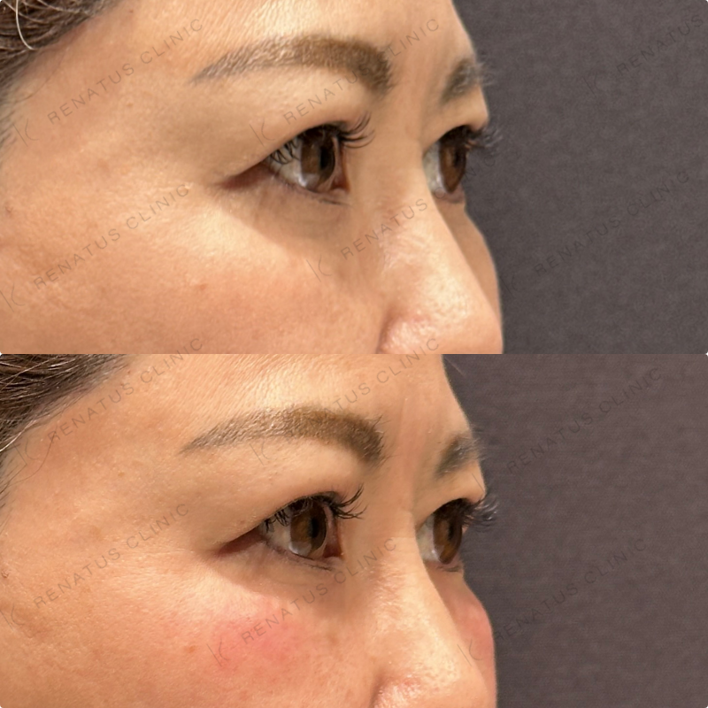 目の下ヒアルロン酸ボルベラ症例写真