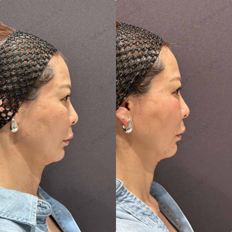 目の下ヒアルロン酸ボルベラ症例写真