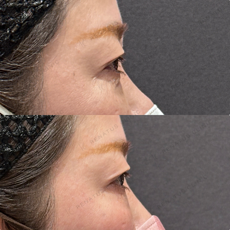 目の下ヒアルロン酸ボルベラ症例写真