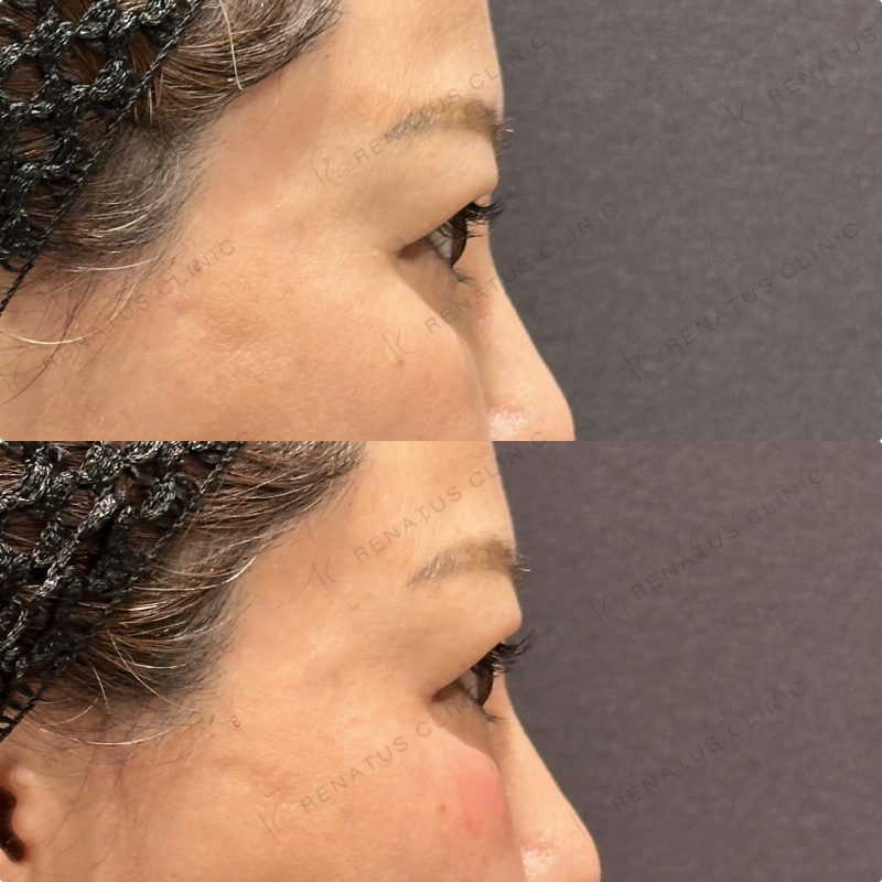 目の下ヒアルロン酸ボルベラ症例写真