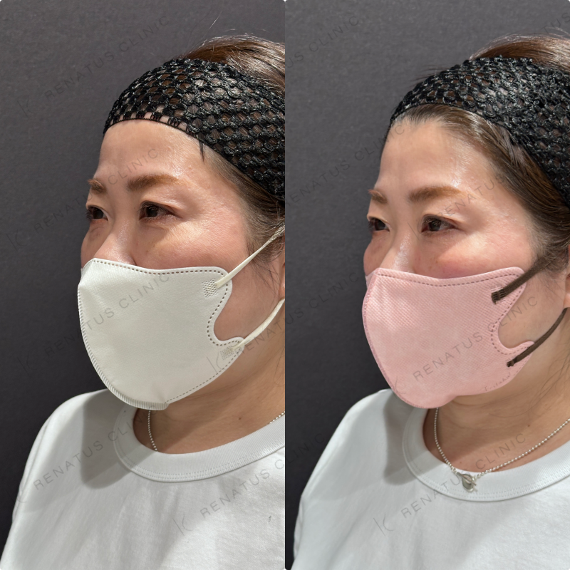 目の下ヒアルロン酸ボルベラ症例写真