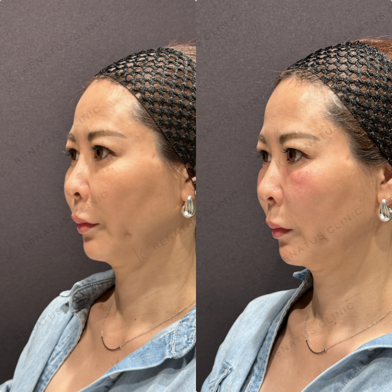 目の下ヒアルロン酸ボルベラ症例写真