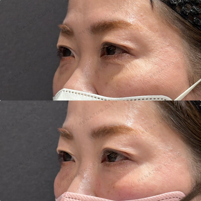 目の下ヒアルロン酸ボルベラ症例写真