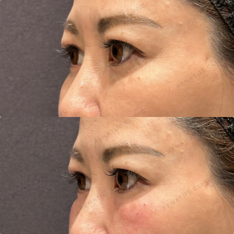 目の下ヒアルロン酸ボルベラ症例写真