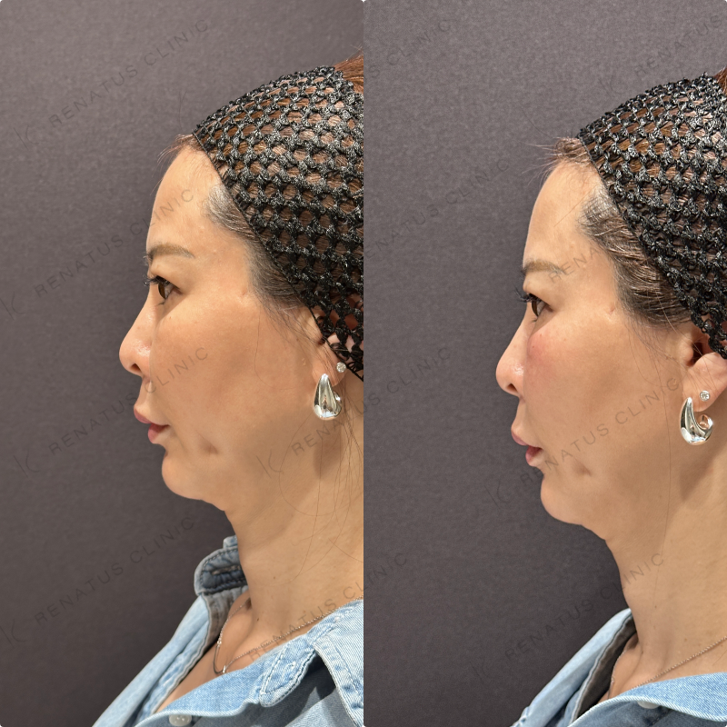 目の下ヒアルロン酸ボルベラ症例写真