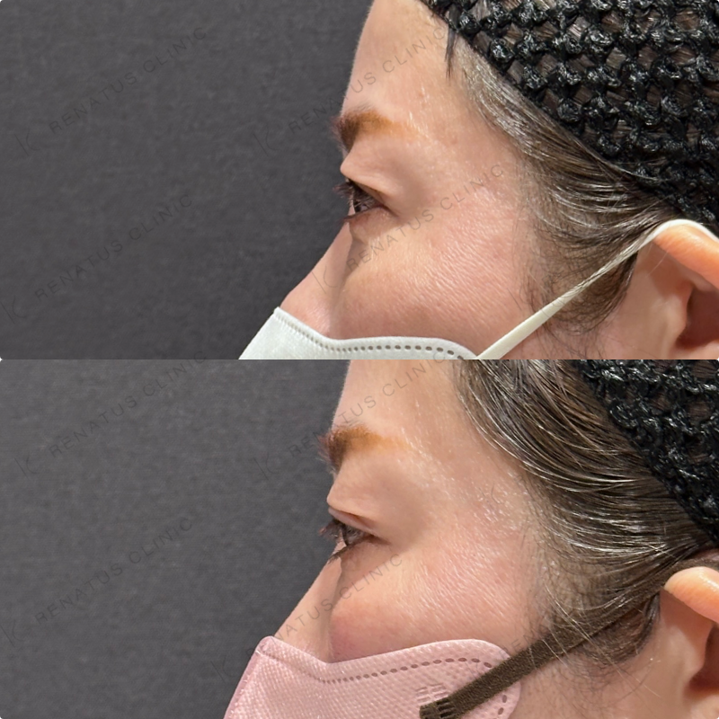 目の下ヒアルロン酸ボルベラ症例写真