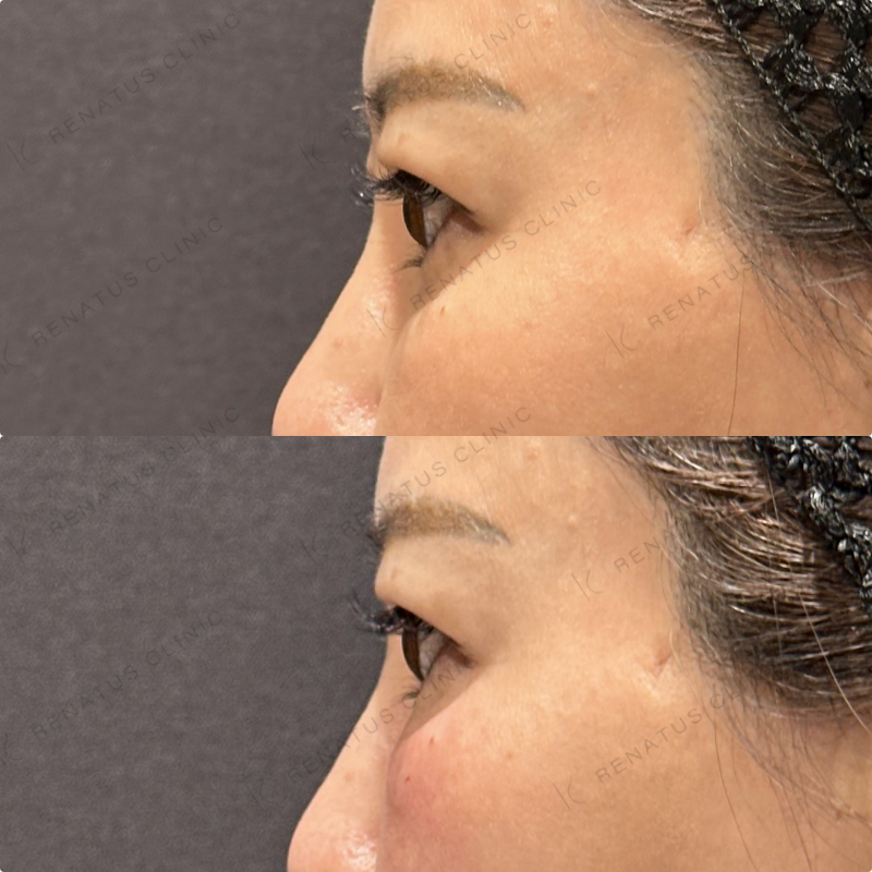 目の下ヒアルロン酸ボルベラ症例写真