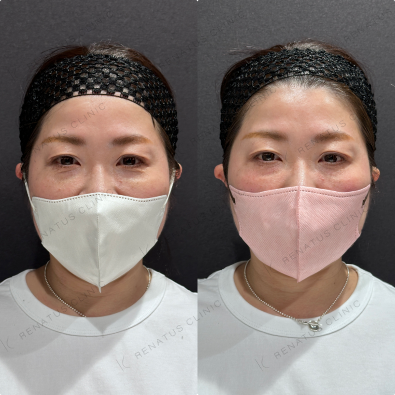 目の下ヒアルロン酸ボルベラ症例写真