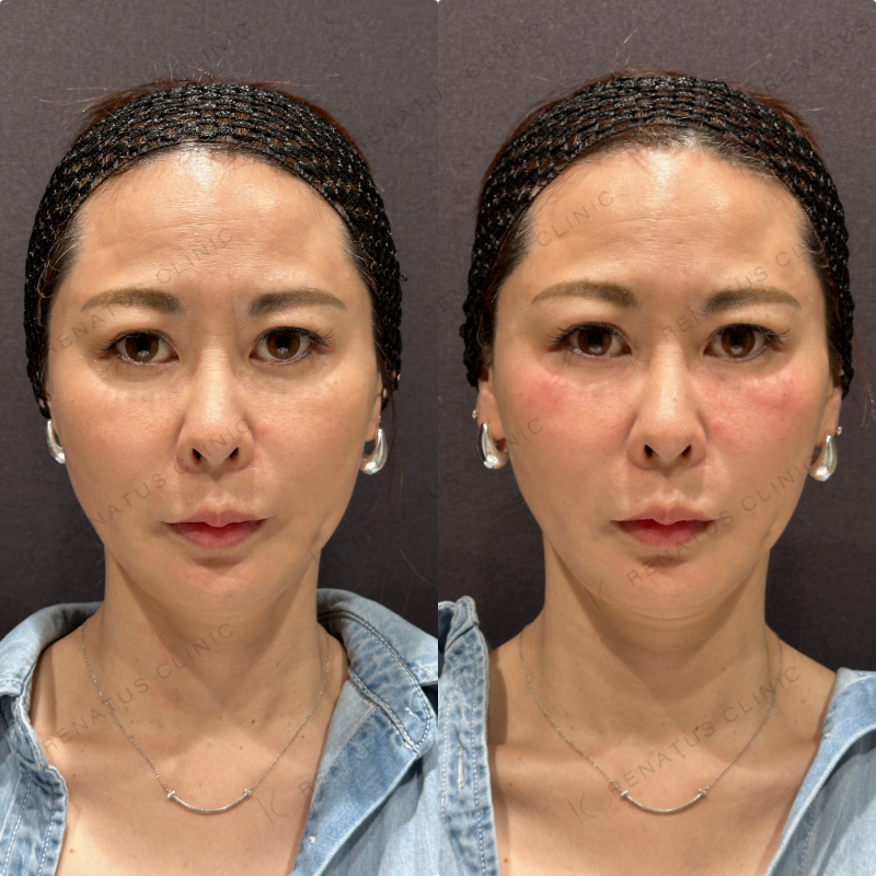 目の下ヒアルロン酸ボルベラ症例写真