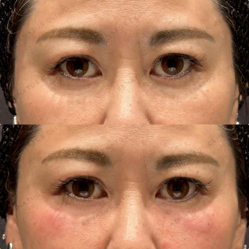 目の下ヒアルロン酸ボルベラ症例写真