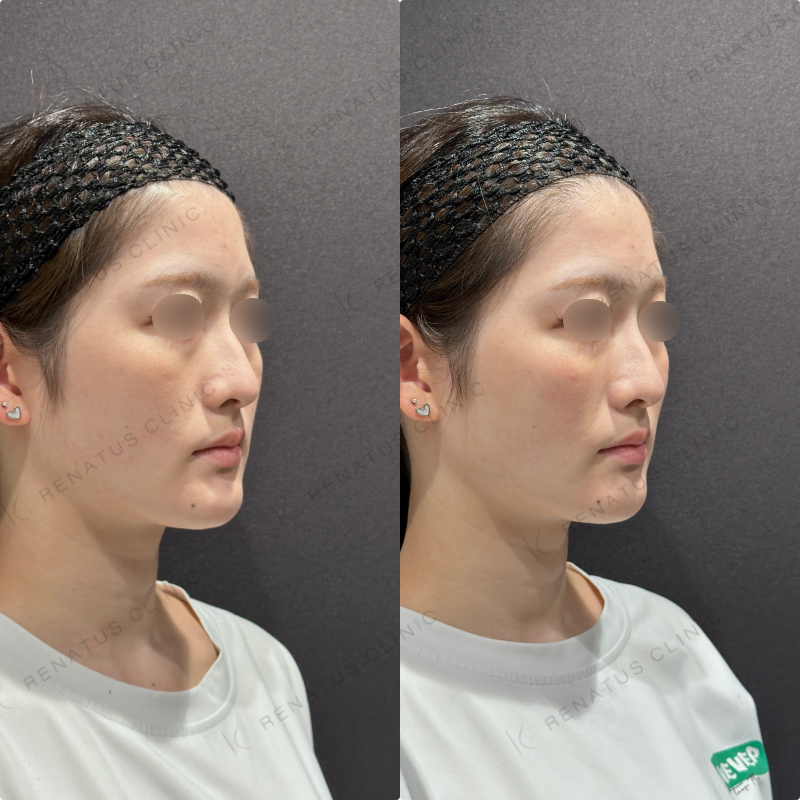 頬ヒアルロン酸ダイヤモンドフィール症例写真