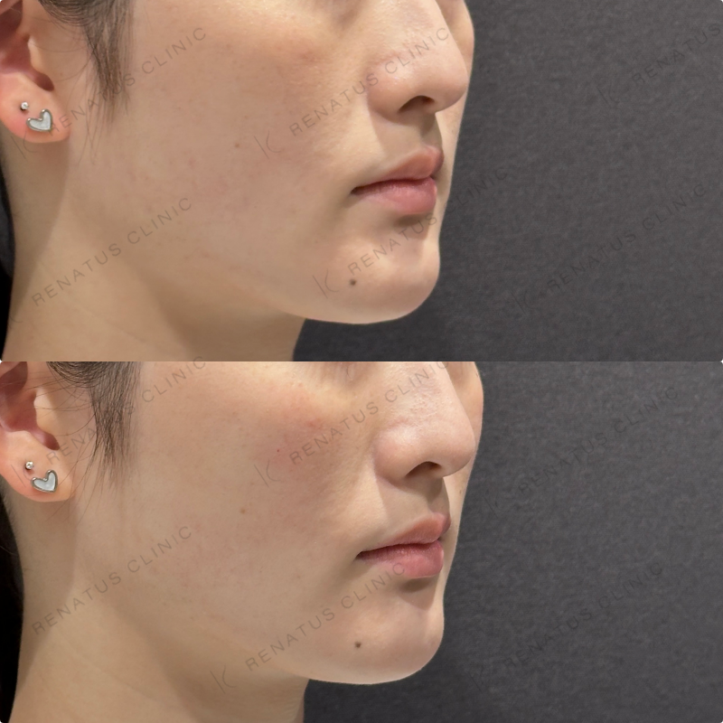 頬ヒアルロン酸ダイヤモンドフィール症例写真