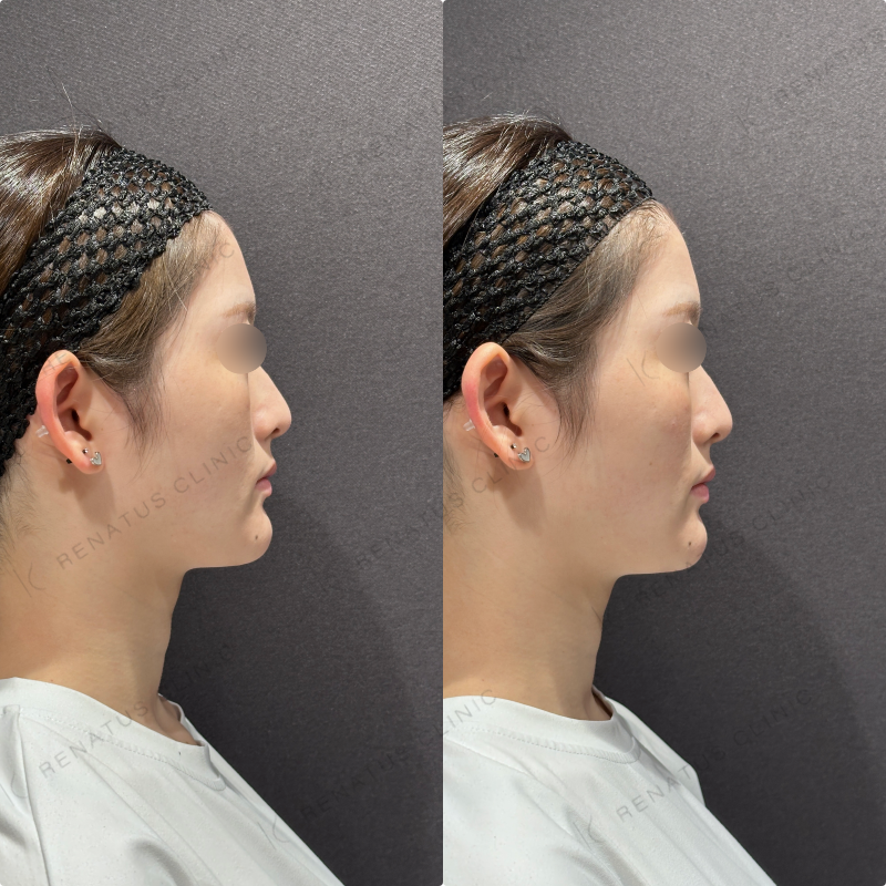 頬ヒアルロン酸ダイヤモンドフィール症例写真