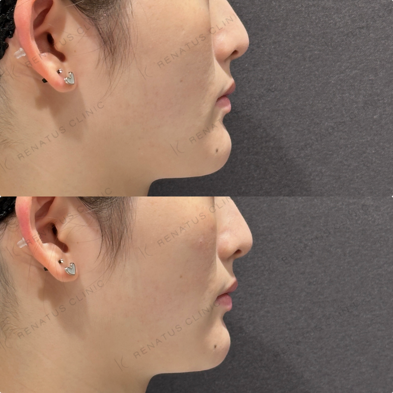 頬ヒアルロン酸ダイヤモンドフィール症例写真