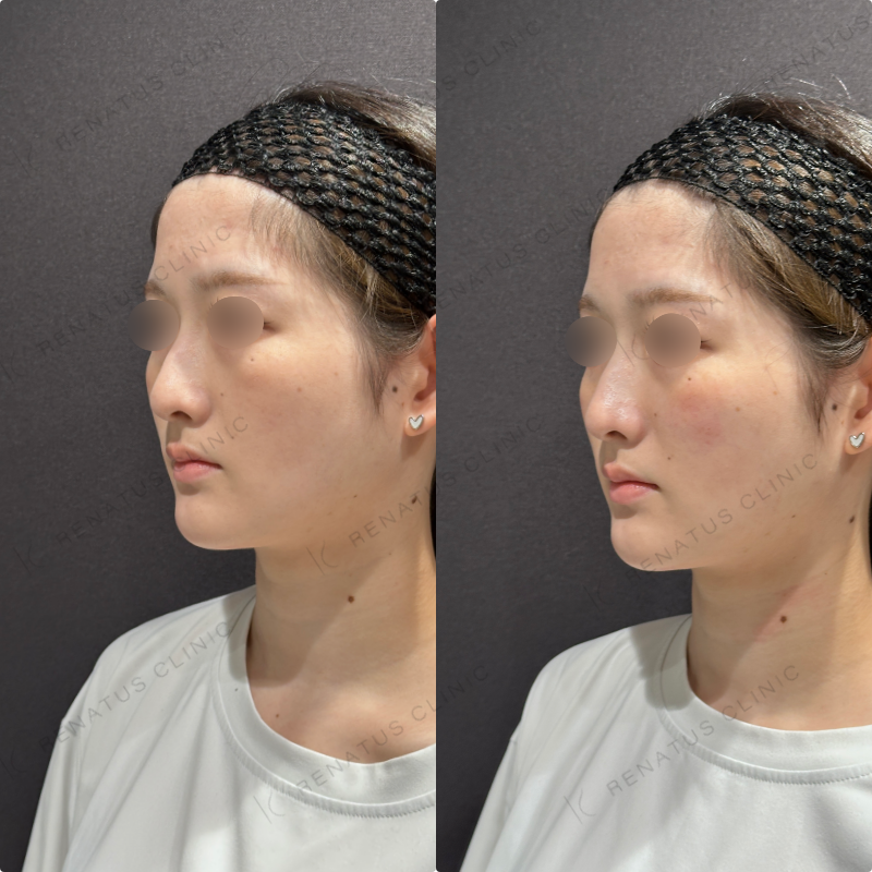 頬ヒアルロン酸ダイヤモンドフィール症例写真