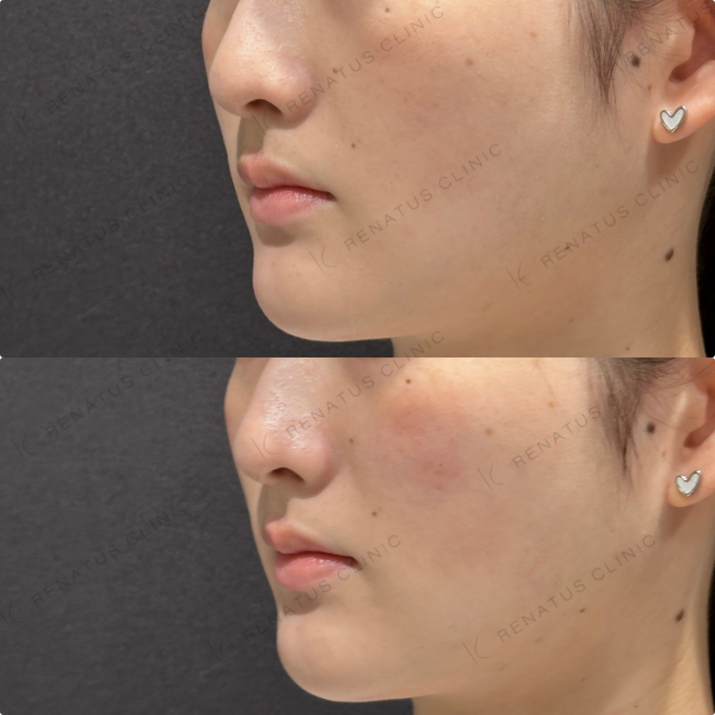 頬ヒアルロン酸ダイヤモンドフィール症例写真