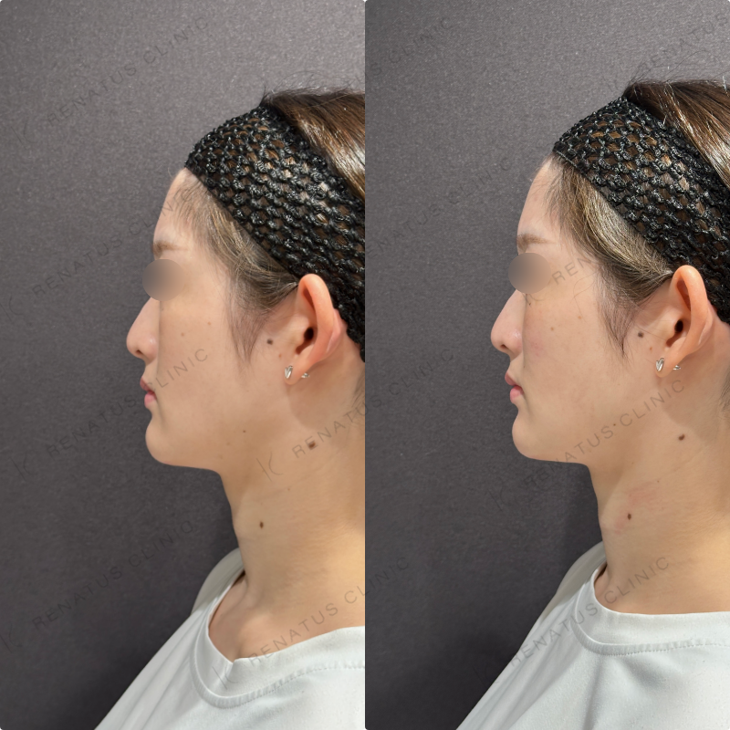 頬ヒアルロン酸ダイヤモンドフィール症例写真