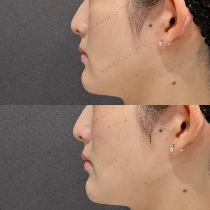 頬ヒアルロン酸ダイヤモンドフィール症例写真