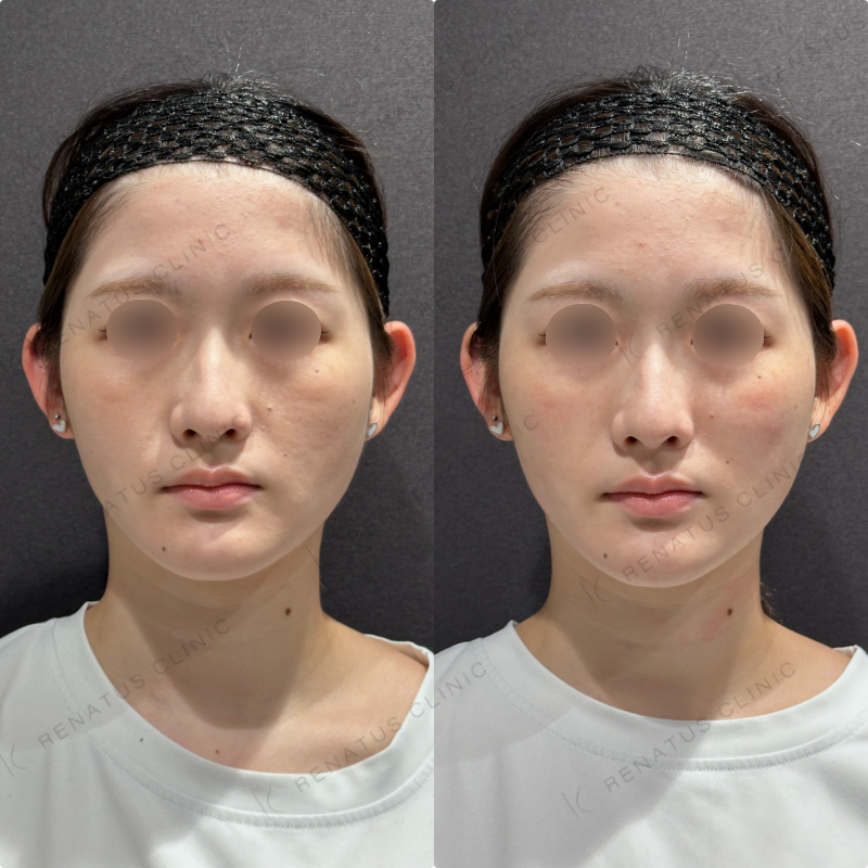 頬ヒアルロン酸ダイヤモンドフィール症例写真