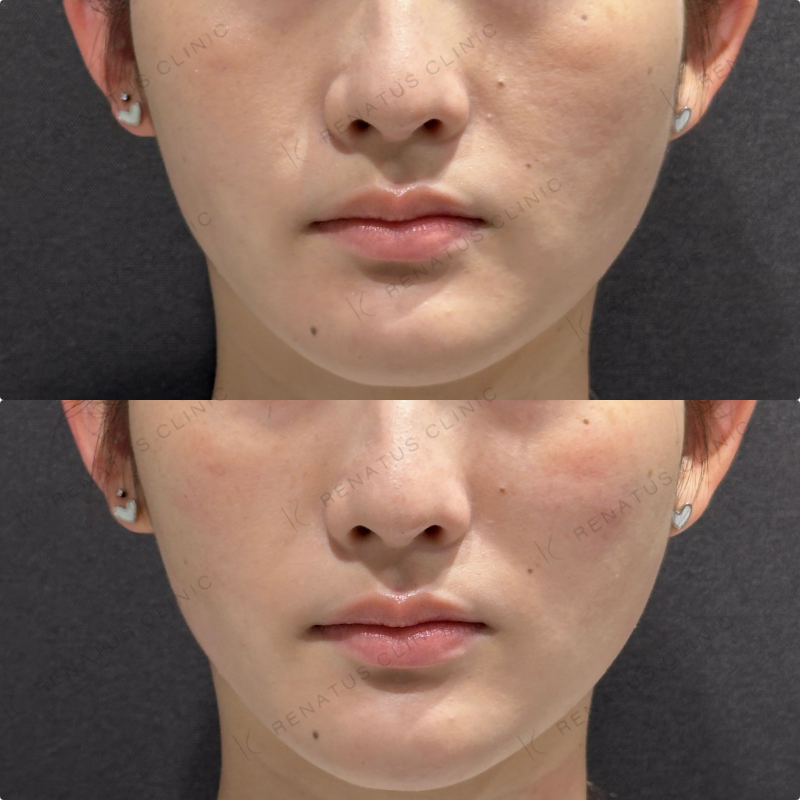 頬ヒアルロン酸ダイヤモンドフィール症例写真