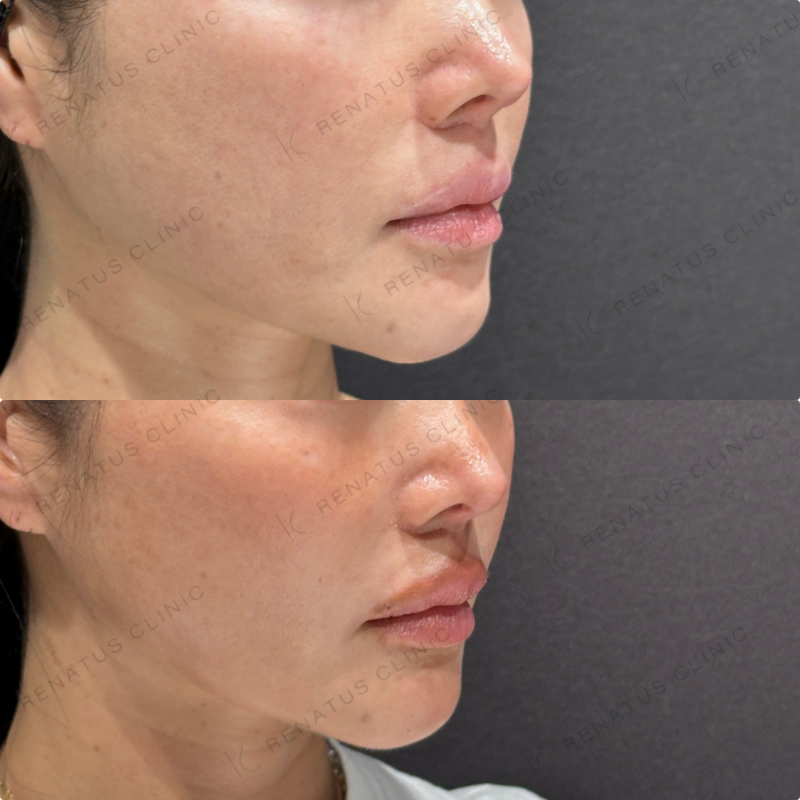 頬ヒアルロン酸ボライト症例写真