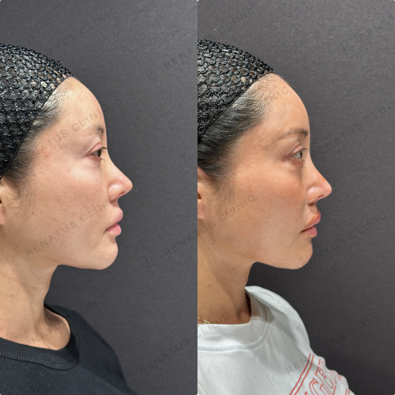 頬ヒアルロン酸ボライト症例写真