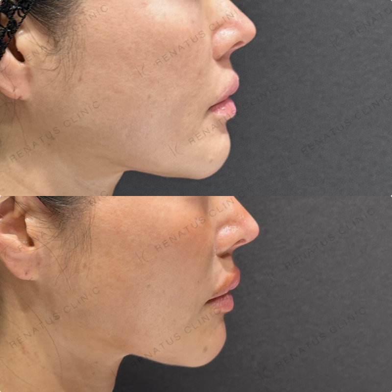 頬ヒアルロン酸ボライト症例写真