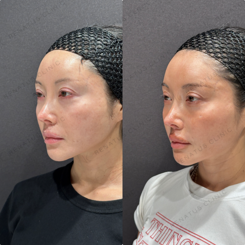 頬ヒアルロン酸ボライト症例写真