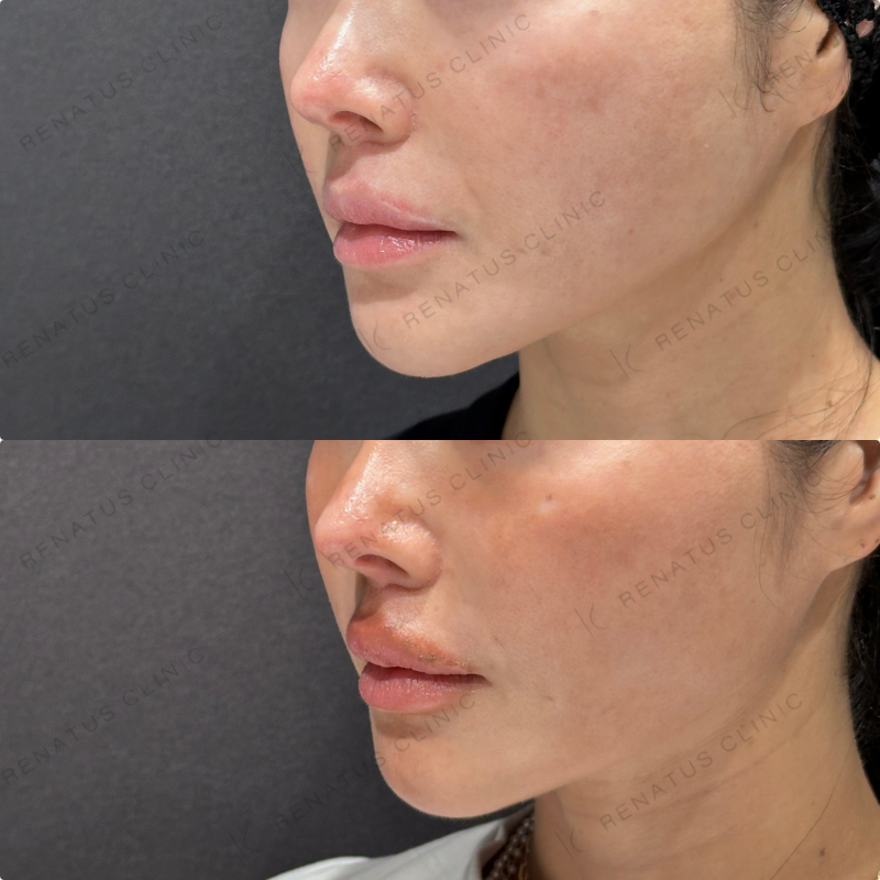 頬ヒアルロン酸ボライト症例写真