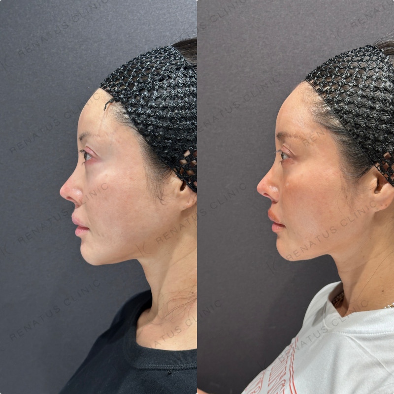 頬ヒアルロン酸ボライト症例写真